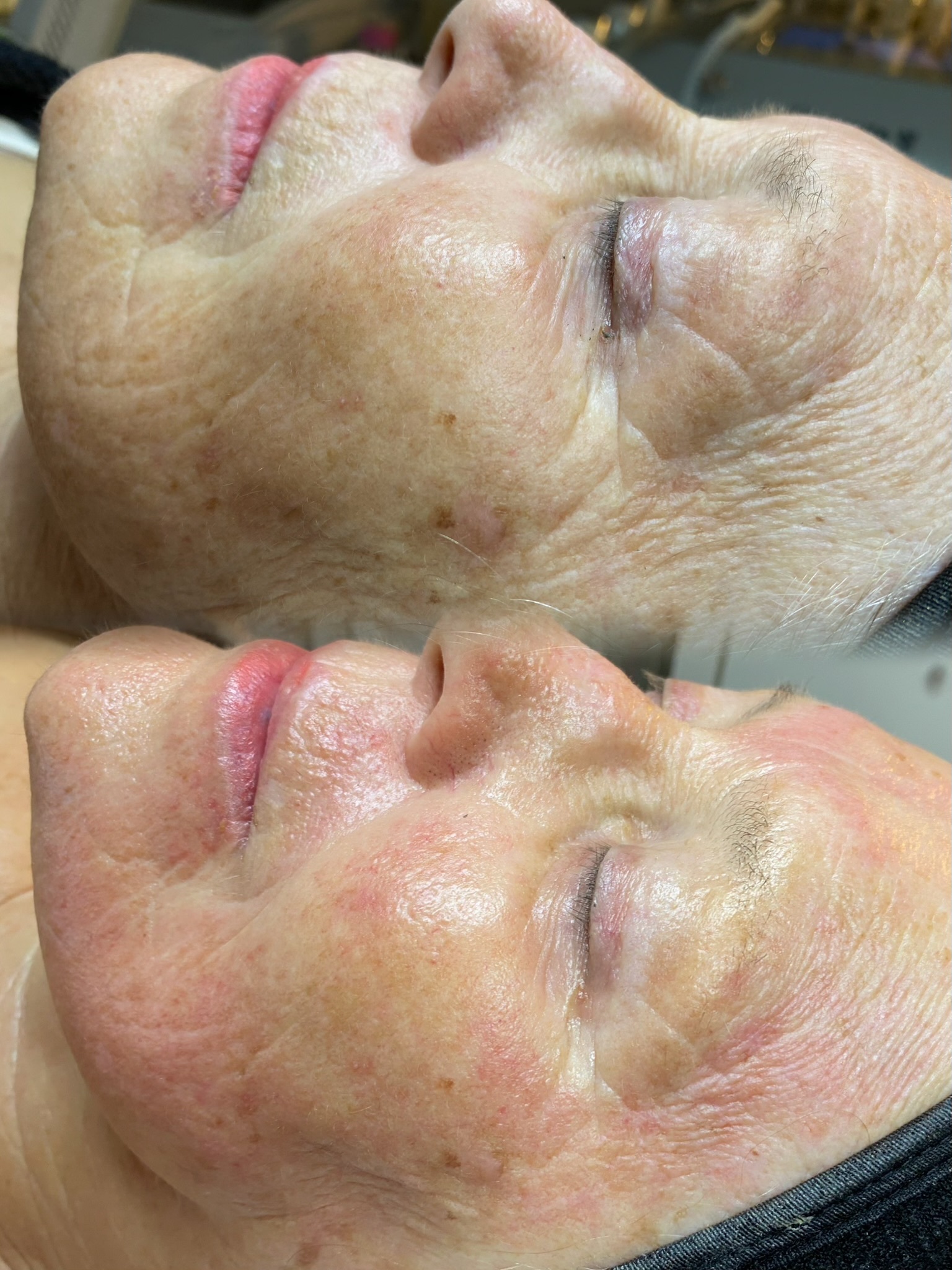 Výsledek po 1 ošetření ExoLift – zvýšená napětí a zářivý vzhled pleti.